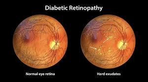 Diabetic eye screening